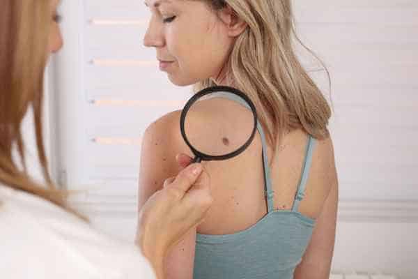 What Are Traditional Skin Lesion Removal Methods Oldham?