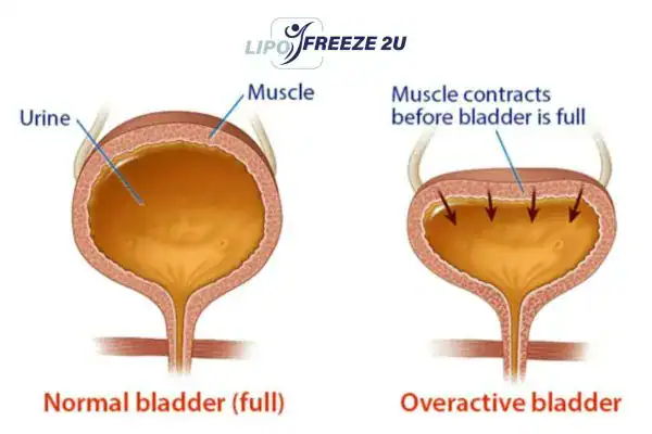 diagram of overactive bladder treatment Oldham
