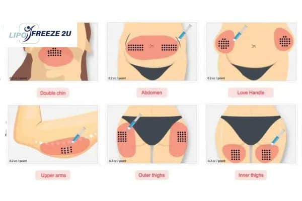 Benefits of Choosing Aqualyx for Fat Reduction Oldham