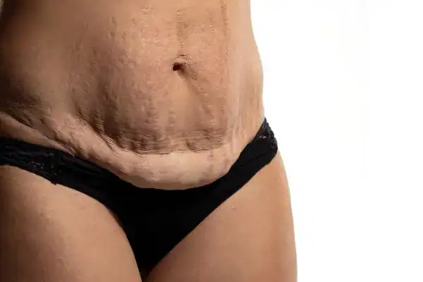 loose skin after weight loss injections Oldham