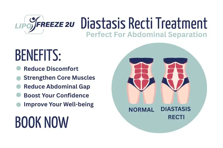 How Long Will It Take to See Improvements in Diastasis Recti Oldham