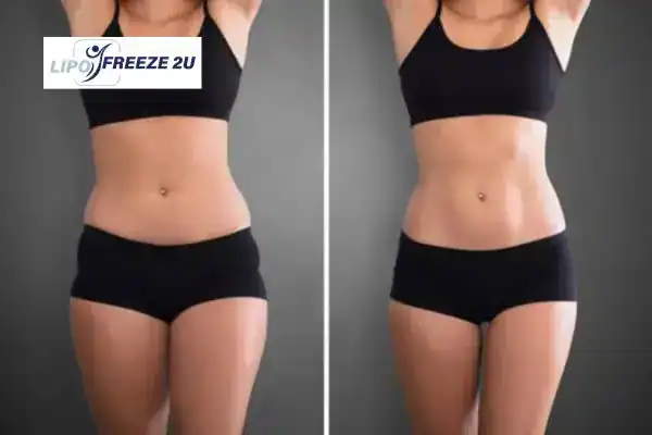 How Can LIPO FREEZE 2U Support Your Post-Pregnancy Body Recovery Oldham?